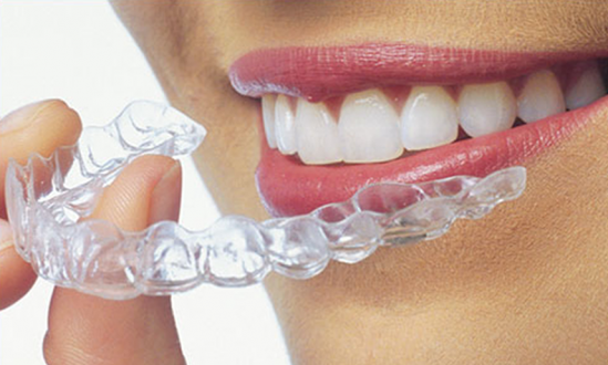 Active aligners Cape town SA